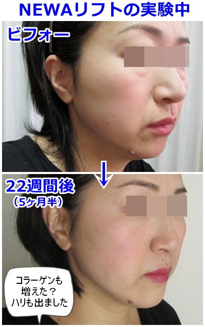 b-newalift22week-before-after
